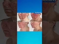 HIFU vs. frakcyjny laser CO2, który wolisz?